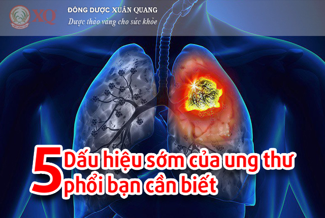 5 dấu hiệu sớm của ung thư phổi bạn cần biết